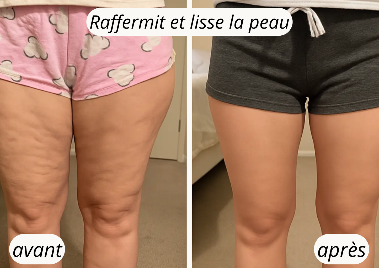 DermaLift – Retrouver des jambes fermes et lisses, sans chirurgie